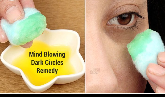 Home remedies to treat dark circles at home Dark circles remedy